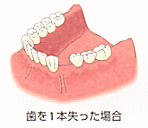 インプラント