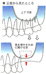 インプラント