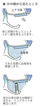 インプラント